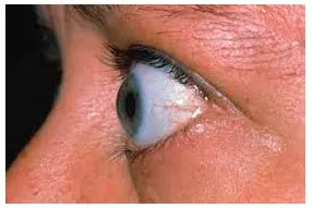Memory trick for Protrusion