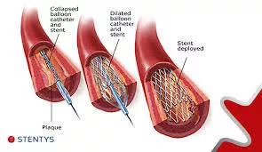 Stents are not the magic wand