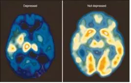 Long term depression permanently changes the brain