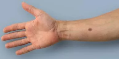 Earlier cancer detection could be just an artificial mole away