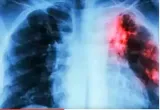 Heed the grim tb reminder of diseases beyond covid