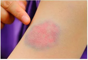 Bruise  - A mark indicating an area of damage on a fruit, vegetable, or plant.
