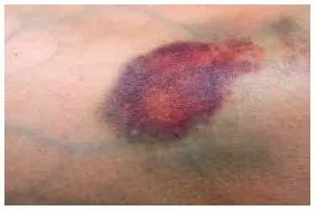 Bruise - A blue, brown or purple mark that appears on the skin after somebody has fallen, been hit, etc.