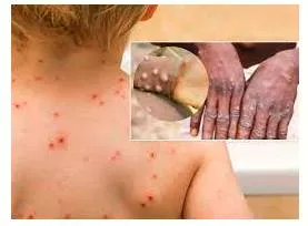 Monkeypox cases triple in europe  who says