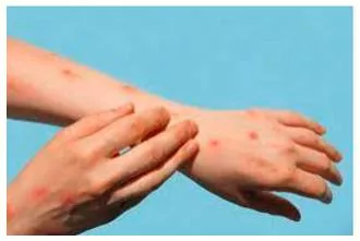 Learning lessons  on a strategy for monkeypox