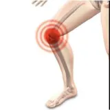 Osteoarthritis  here's how stem cell therapy works as pain relief to heal knee joint swelling