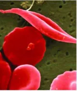 U s  fda approves pair of gene therapies for sickle cell disease