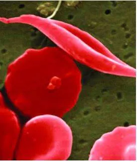 U s  fda approves pair of gene therapies for sickle cell disease