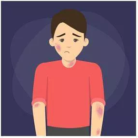 Bruised - An injury involving rupture of small blood vessels and discoloration without a break in the overlying skin.