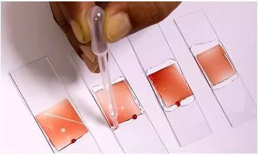 Lancet report validates india’s stigma study for sickle cell disease  terms it a ‘robust tool’