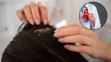 Can seborrheic dermatitis or dandruff be a hidden sign of HIV? Expert weighs in on viral claim