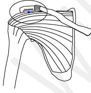 Impinged - (To produce an effect, usually an unwanted one)