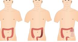 Colostomy  - It is an opening in the abdominal wall that’s made during surgery.