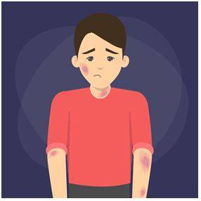 Bruised - An injury involving rupture of small blood vessels and discoloration without a break in the overlying skin.